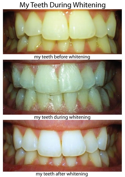 My Teeth Before, During And After Whitening With Crest Whitestrips