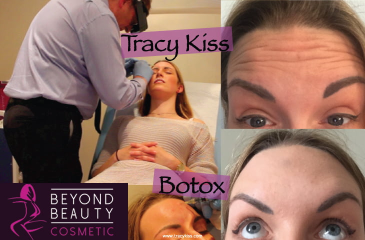 Tracy Kiss Botox At Beyond Beauty Cosmetic London