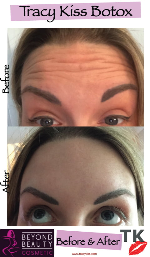 Tracy Kiss Botox Before And After