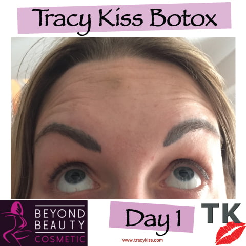 Tracy Kiss Botox Day 1