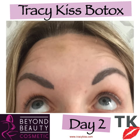 Tracy Kiss Botox Day 2