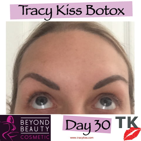 Tracy Kiss Botox Day 30