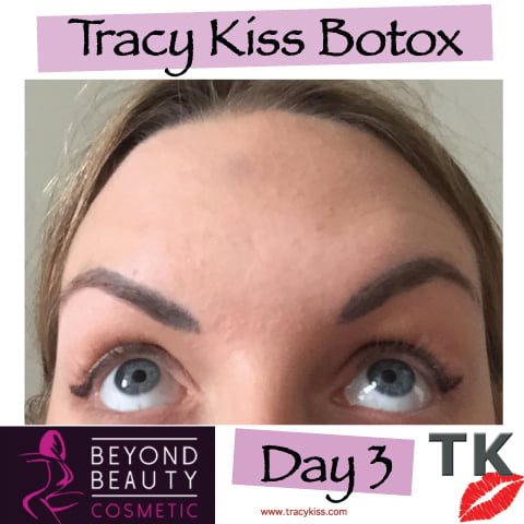 Tracy Kiss Botox Day 3
