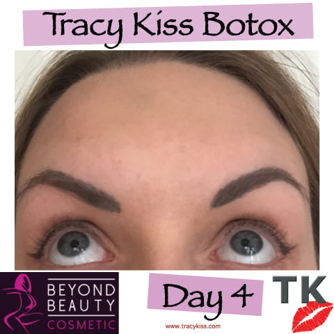 Tracy Kiss Botox Day 4