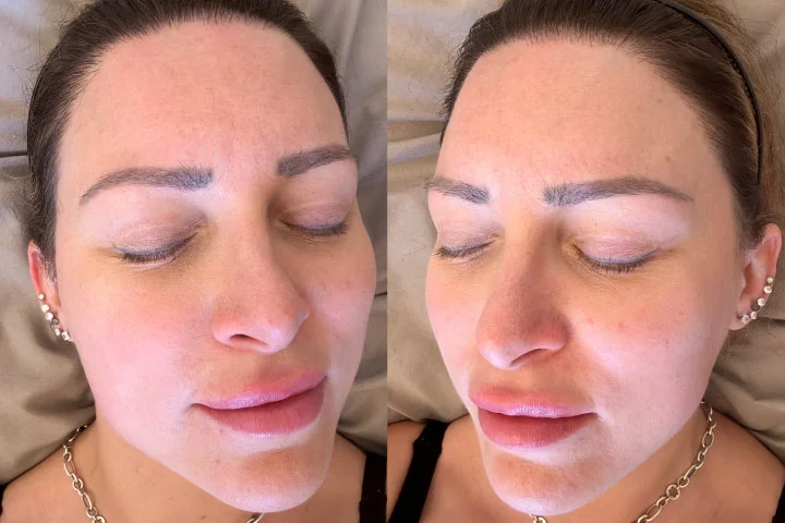Microneedling: Your Ticket To A Naturally Youthful Glow - Tracy Kiss